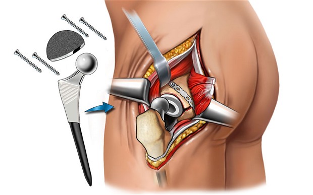 Surgery for hips