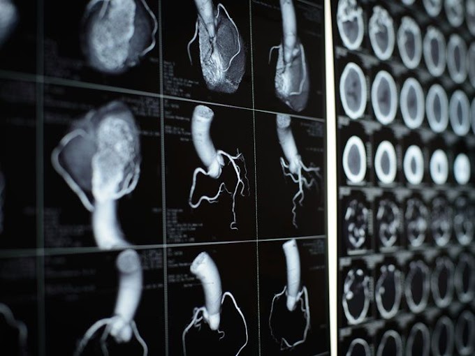 Cardiac CT Scan: Function, Procedure, and Side Effects