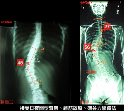 脊椎側彎, 脊椎側彎 矯正, 脊椎側彎治療