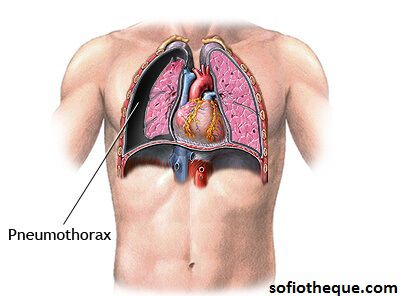 Cours PDF | Pneumothorax : CAT en situation d'urgence, Diagnostic