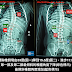 脊椎側彎矯正案例8 - 10歲治療七週33~15.5度+後續追蹤(胸椎側彎9個月進步19.5度)