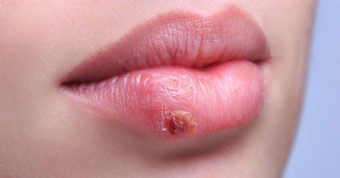 what is causes a cold sores? 