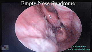cold turbinate,ENS,Nasal physiology,Empty Nose Syndrome,healthy turbinates,Nasal Hyperventilation,