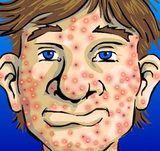 remedios caseros para el acne