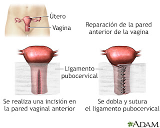 Cirugía ginecológica reconstructiva y estética en Guadalajara Mexico. Vaginoplastia o reconstrucción vaginal