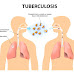 Suffering from TB: Improve your immune system by a better diet