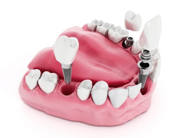 Impianti dentali a Tirana/Albania, fasi di trattamento