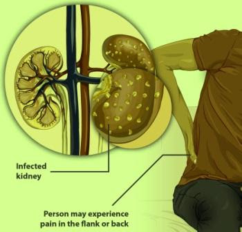 Kidney disease