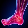 Chronic Venous Insufficiency CVI