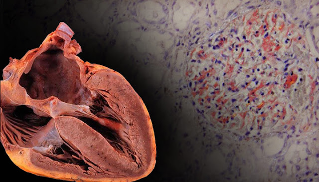 Familial amyloid cardiomyopathy (FAC)