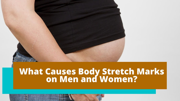 What Causes Body Stretch Marks on Men and Women?