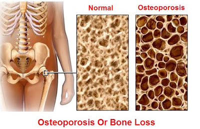 osteoporosis: causes, signs-symptoms, diagnosis and treatment