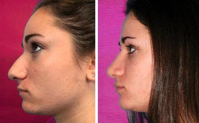 Rhinoplasty Before After