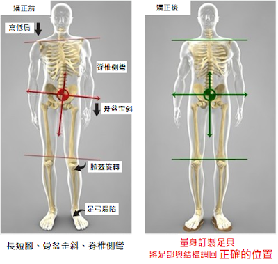 什麼是長短腳可以透過運動治療改善嗎 Dr Foot 達特富科技股份有限公司 足弓鞋墊 訂做鞋墊 矯正鞋墊 什麼是長短腳可以透過運動治療改善嗎 Dr Foot 達特富科技股份有限公司 足弓鞋墊 訂做鞋墊 矯正鞋墊