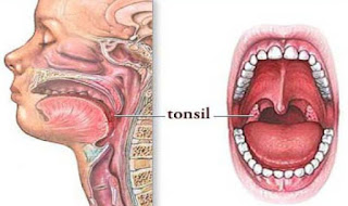 Amandel Atau Tonsil