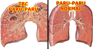 Tuberkulosis (TBC)