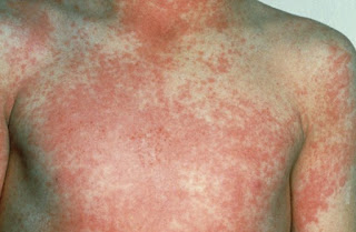 severe rash on the chest due to scarlet fever  caused by Streptococal bacteria