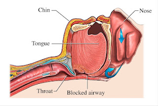 Artikel, Sleep Apnea, Sleep Apnea Adalah, Jenis Sleep Apnea, Gejala Sleep Apnea, Pengobatan Sleep Apnea