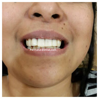 foto, gambar, gigi depan keropos Permata Dental Bali| sebelum dan sesudah gigi keropos diperbaiki di Permata Dental Bali | foto gigi keropos hitam Permata Dental Bali |gigi keropos karena sakit | gigi keropos berlubang | gigi keropos depan| gigi keropos bagian belakang | foto gigi keropos yang sudah diperbaiki Permata Dental Bali |  gigi keropos bagian depan| foto gigi keropos dan patah, foto gigi keropos oleh Permata Dental Bali, Bali Hits, Bali banget, area Bali, Bali kota, area kampus bali. veneer gigi keropos  Bali | veneer gigi keropos badung | veneer gigi keropos nusadua | veneer gigi keropos ngurahrai| veneer gigi keropos denpasar | veneer gigi kropos denpasar kota | veneer gigi keropos Bali | veneer gigi keropos gatsu | |veneer gigi keropos|  depan | veneer gigi keropos  atas | veneer gigi keropos  bawah | veneer gigi keropos  belakang |veneer gigi berlubang bali| veneer gigi berlubang Bali | veneer gigi berlubang nusadua| veneer gigi berlubang ngurahrai| veneer gigi berlubang Badung | veneer gigi berlubang depasar kota | veneer gigi berlubang denpasar| veneer gigi berlubang gatsu| veneer gigi berlubang jimbaran| veneer gigi berlubang bagus Permata Dental Bali | veneer gigi berlubang baik di Permata Dental Bali | veneer gigi berlubang cepat di Permata Dental Bali | veneer gigi berlubang murah di Permata Dental Bali | veneer gigi berlubang aman | veneer gigi berlubang mudah di Permata Dental Bali | veneer gigi berlubang promo Permata Dental Bali | gambar veneer gigi berlubang Permata Dental Bali | gambar sebelum dan sesudah veneer gigi hitam dan berlubang  veneer gigi hitam Bali | veneer gigi hitam Bali | veneer gigi hitam denpasar | veneer gigi hitam jimbaran | veneer gigi hitam nusadua | veneer gigi hitam Bali kota | veneer gigi hitam ngurahrai| veneer gigi hitam badung | veneer gigi hitam gatsu | veneer gigi hitam bagus | veneer gigi hitam baik | veneer gigi hitam cepat di Permata Dental Bali | veneer gigi hitam murah di Permata Dental Bali | veneer gigi hitam aman | veneer gigi hitam mudah di Permata Dental Bali | veneer gigi hitam promo Permata Dental Bali | gambar veneer gigi hitam Permata Dental Bali | gambar sebelum dan sesudah veneer gigi hitam dan berlubang Permata Dental