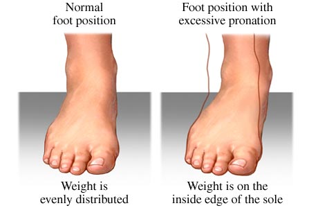 Feet: excessive Dancing pronation for shoes  Pronation