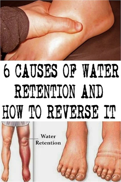 Causes of Water Retention and How to Reverse It