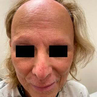Male Pattern Baldness Natural Harbal Oil
