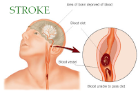 cara untuk mengobati penyakit stroke