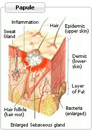 Papule