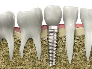 Cấy ghép răng với implant như thế nào?