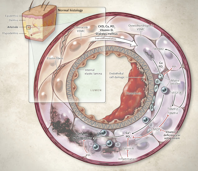 Pathogenesis of Calciphylaxis