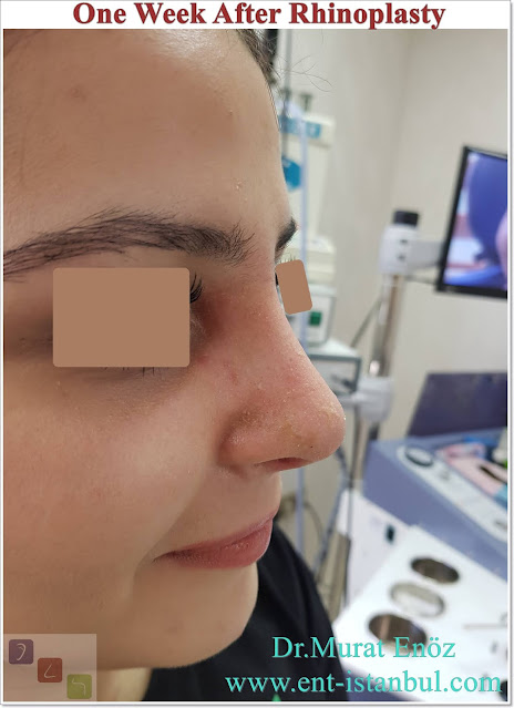 One Week After Rhinoplasty,7 Days After Nose Job, Recovery After Nose Aesthetic Surgery in Istanbul