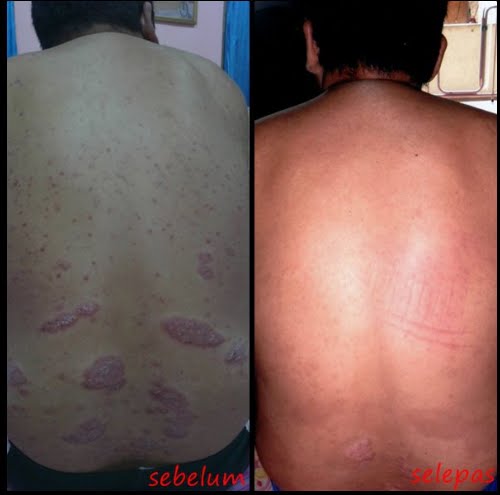 Kegatalan , Kudis Beransur Hilang ~ Rahsia Kecantikan Kegatalan , Kudis Beransur Hilang ~ Rahsia Kecantikan