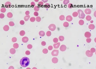 Autoimmune Hemolytic Anemias (AIHA)