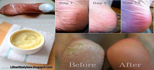 A Cure That Works Wonders: Heals Varicose Veins And Cracked Heels In 10 Days