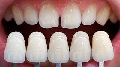 Bọc răng sứ nguyên hàm giá bao nhiêu là được nhất?-1