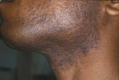 photo of razor burn vs herpes
