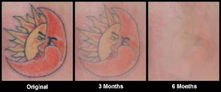 Methods for Teen Tattoo Removal: tattoo art collection888888