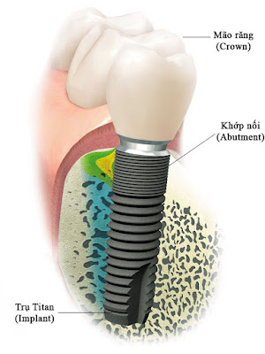 Những lý do nên lựa chọn cấy ghép Implant