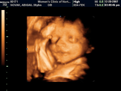 3d ultrasound pictures at 12 weeks. 3d ultrasound 20 weeks