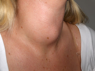 Goiter - thyroid disorder symdrome