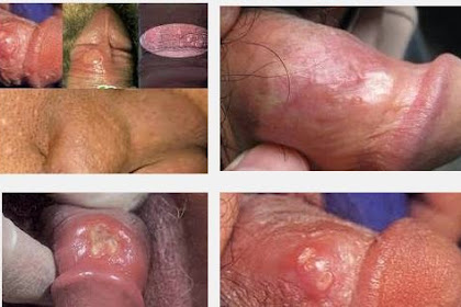 Obat Sipilis Terlaris