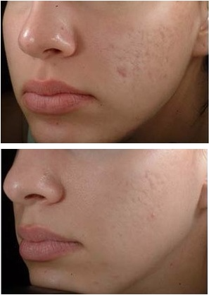 How to Get Rid of Acne Scars Overnight - FITNESS SHORTCUT