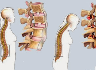 Espondilitis Anquilosante