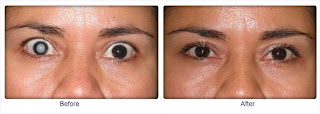 Before and After Cataract Operations