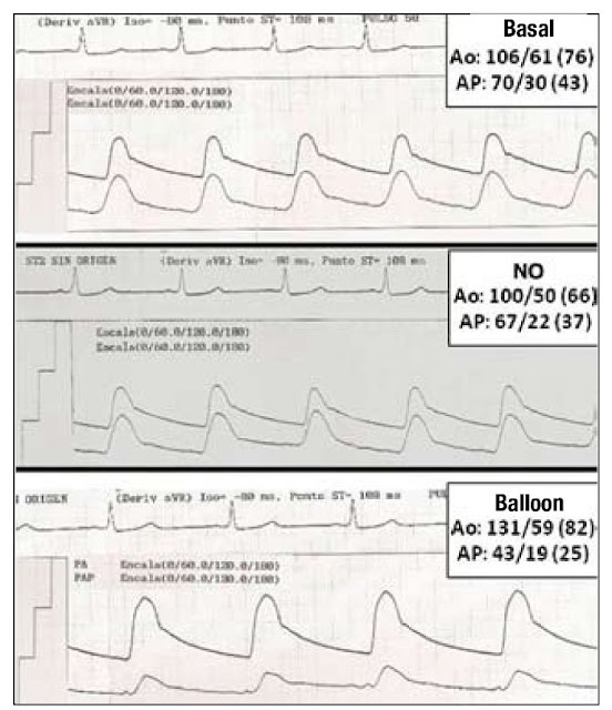 Balloon Occlusion Test6