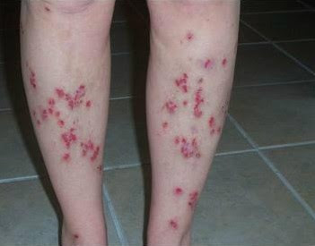 Morgellons Disease Pictures2