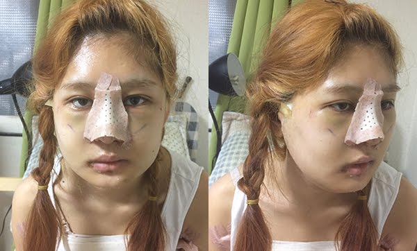 짱이뻐! - People Did Plastic Surgery Because Of This?