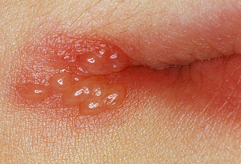 Skin lesions or rash around