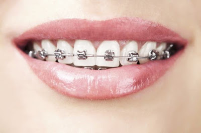 Thông tin từ A - Z về niềng răng mắc cài kim loại