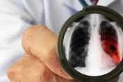 Waspada! Dokter Harvard Ungkap 6 Makanan Penyebab Kanker